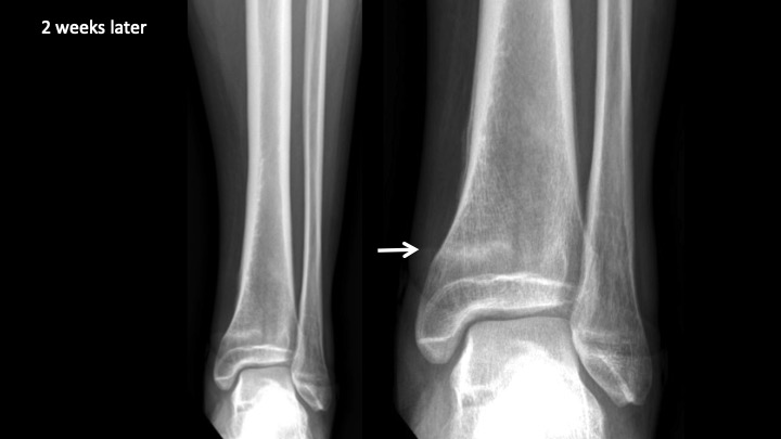 Figure 4 for case osteonecrosis ( RID5180 )